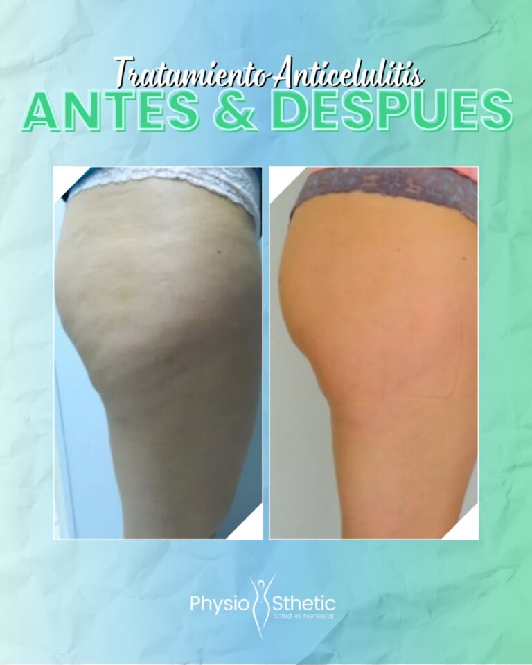 Instagram post from physiosthetic.contacto. This post is in position 8.
